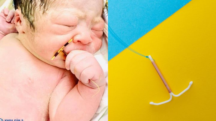 A Baby Was Born in Vietnam, His Mother’s IUD in Tow